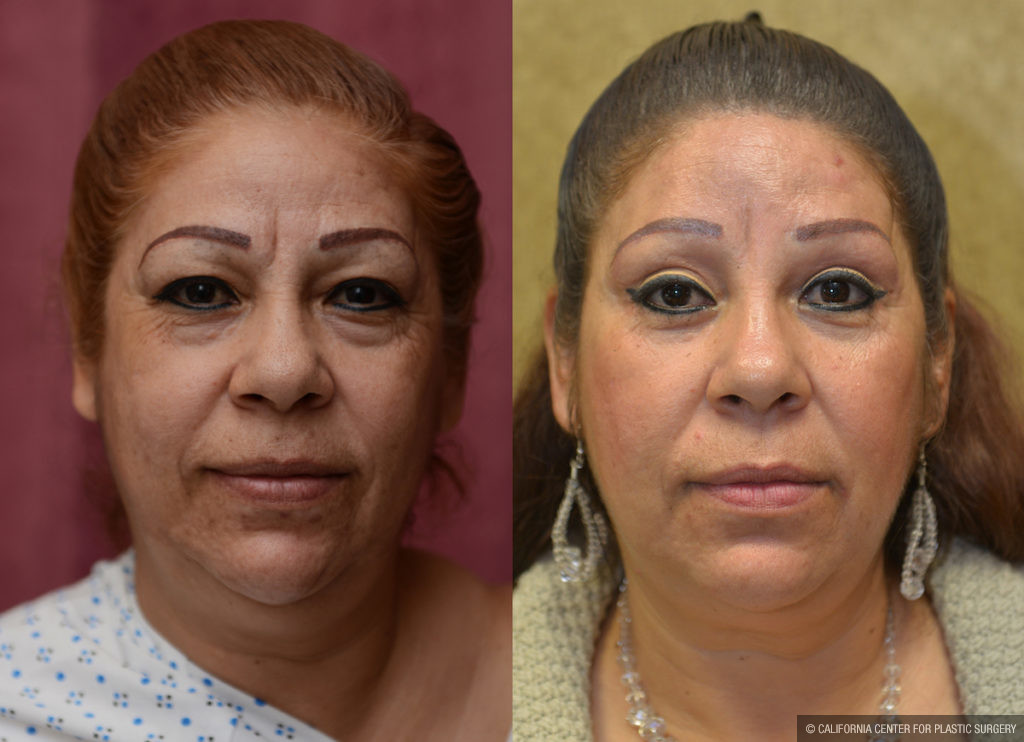 Eyelid (Blepharoplasty) Before & After Patient #11461