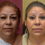Eyelid (Blepharoplasty) Before & After Patient #11461