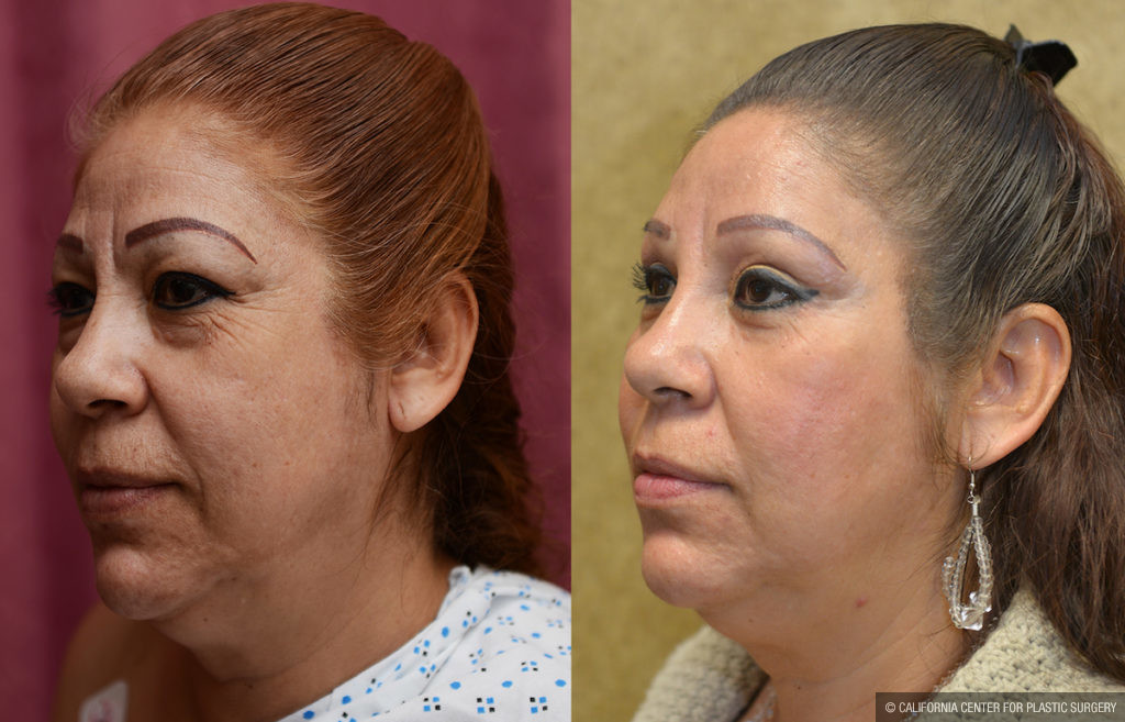 Eyelid (Blepharoplasty) Before & After Patient #11461