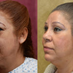 Eyelid (Blepharoplasty) Before & After Patient #11461