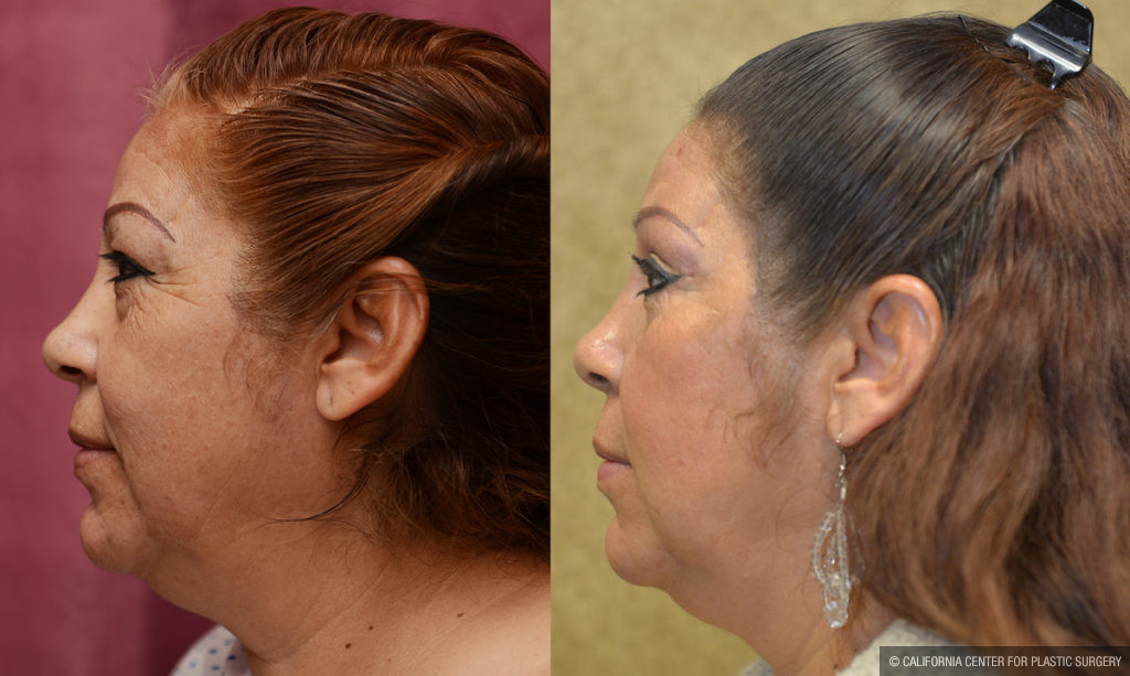 Eyelid (Blepharoplasty) Before & After Patient #11461