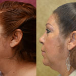 Eyelid (Blepharoplasty) Before & After Patient #11461