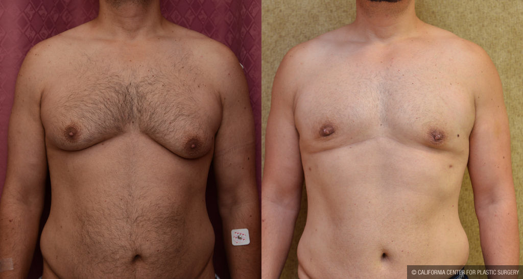 Male gynecomastia (breast) reduction Before & After Patient #11465