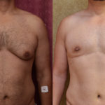 Male gynecomastia (breast) reduction Before & After Patient #11465