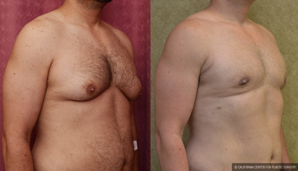 Male gynecomastia (breast) reduction Before & After Patient #11465