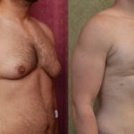 Male gynecomastia (breast) reduction Before & After Patient #11465