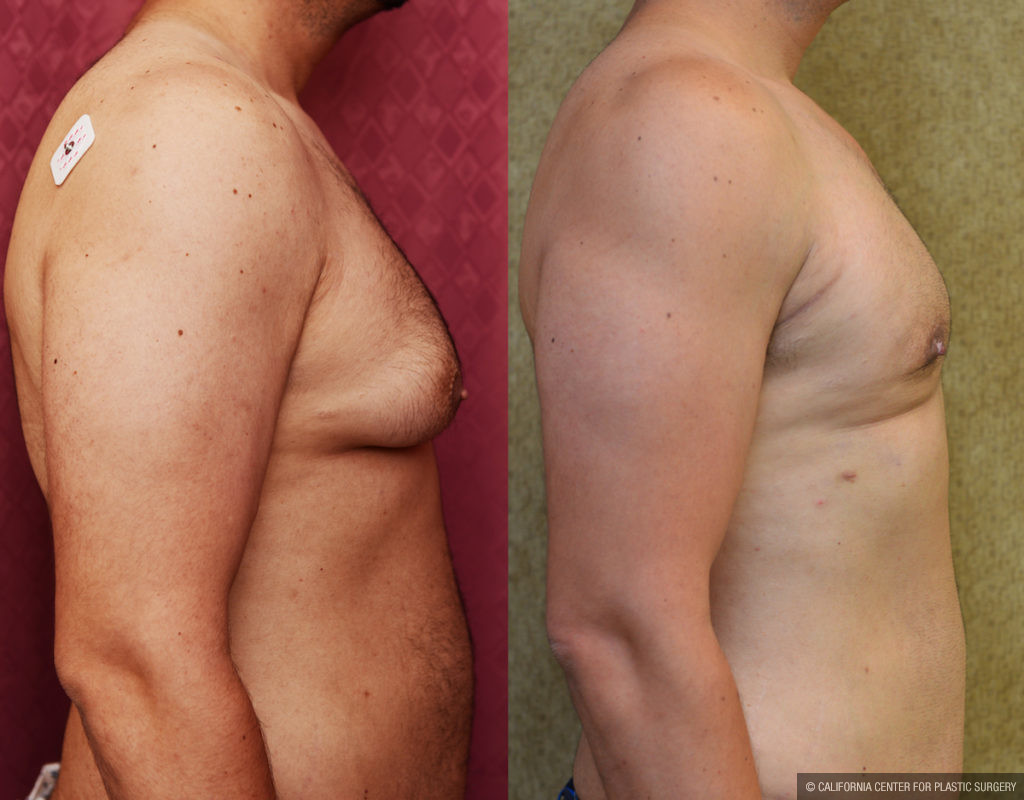 Male gynecomastia (breast) reduction Before & After Patient #11465