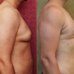 Male gynecomastia (breast) reduction Before & After Patient #11465