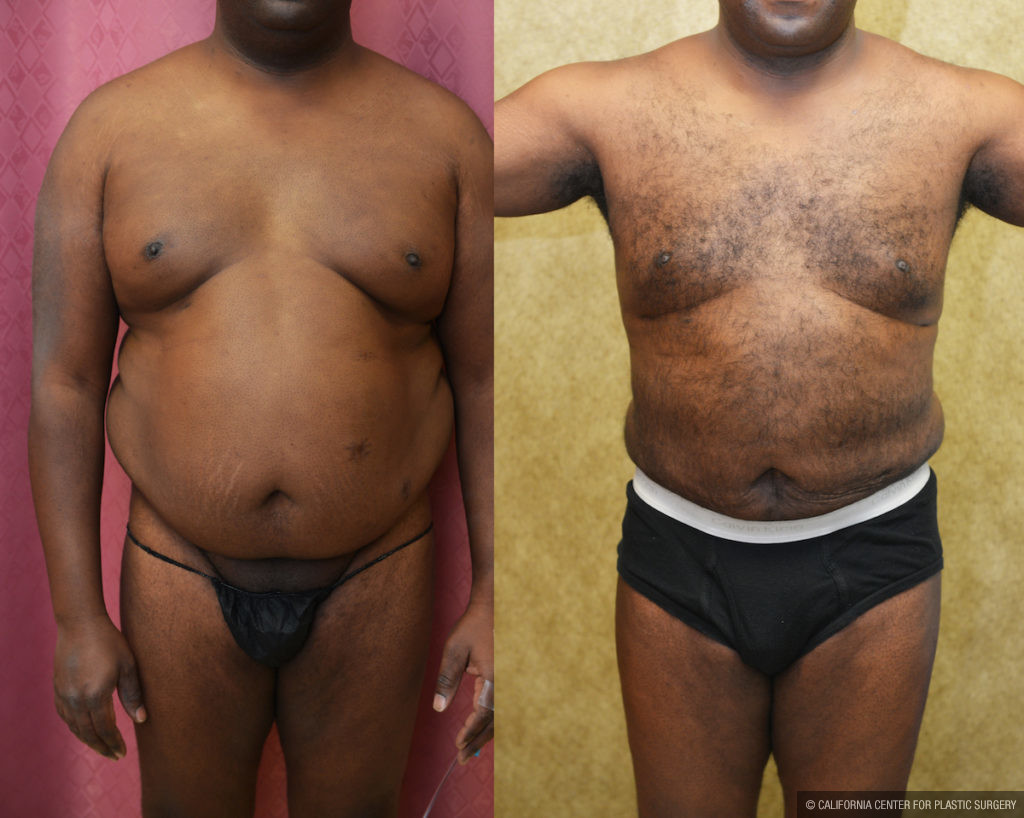 Liposuction Abdomen Medium Before & After Patient #11473