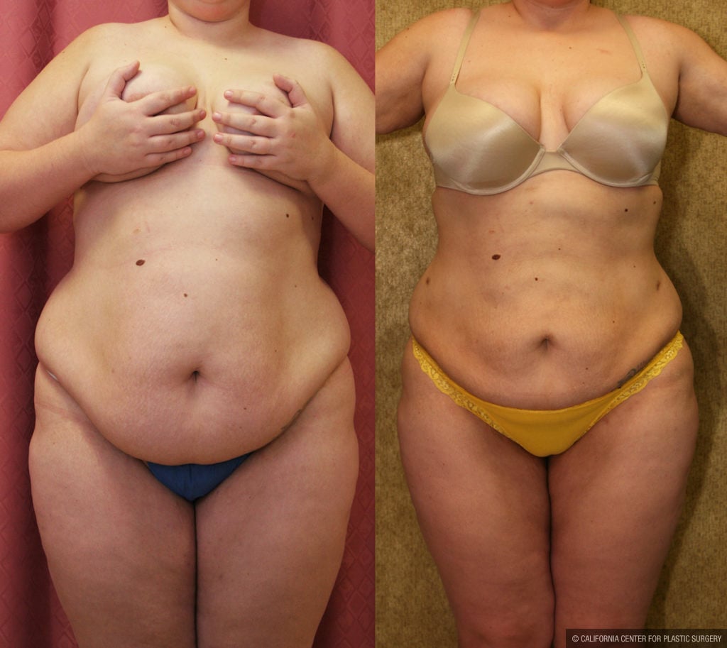 Liposuction Abdomen Plus Size Before & After Patient #11469