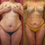 Liposuction Abdomen Plus Size Before & After Patient #11469