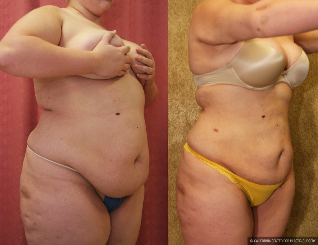 Liposuction Abdomen Plus Size Before & After Patient #11469