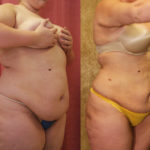 Liposuction Abdomen Plus Size Before & After Patient #11469