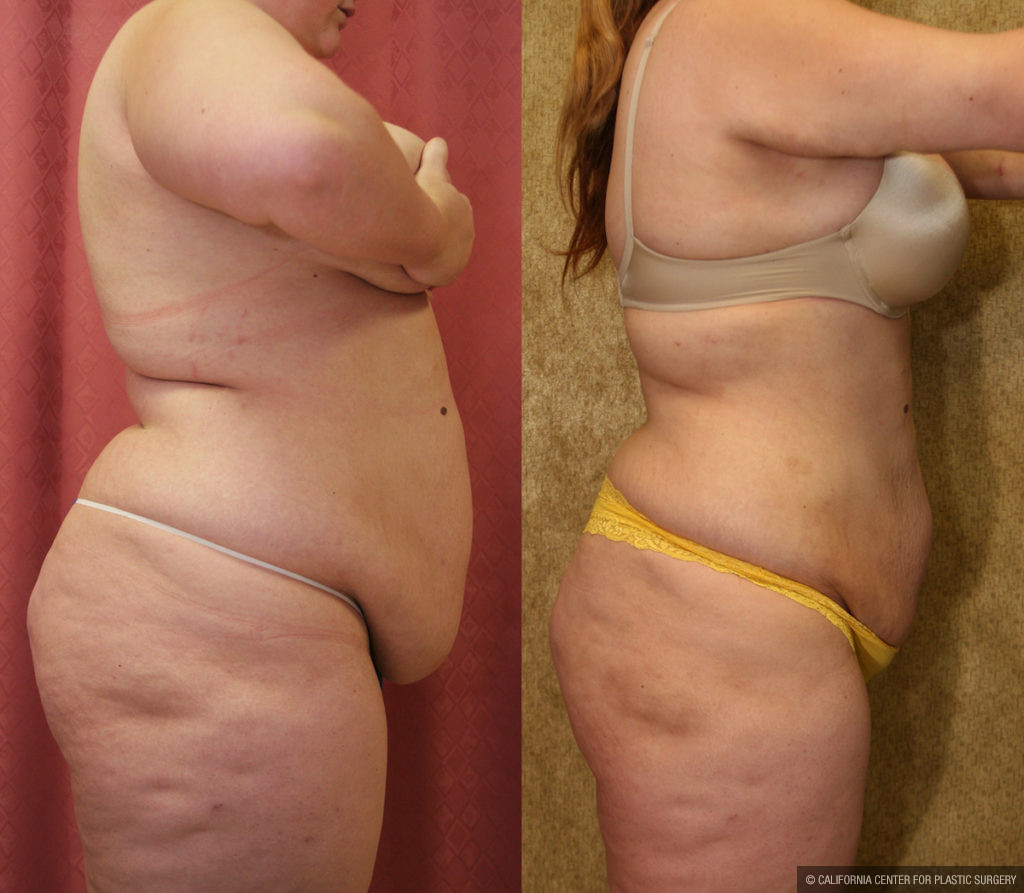 Liposuction Abdomen Plus Size Before & After Patient #11469