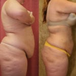 Liposuction Abdomen Plus Size Before & After Patient #11469