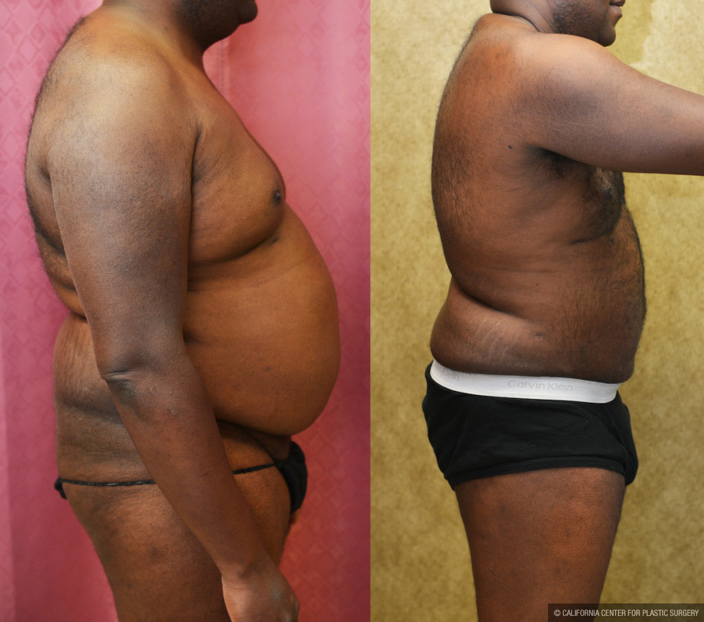 Liposuction Abdomen Medium Before & After Patient #11473