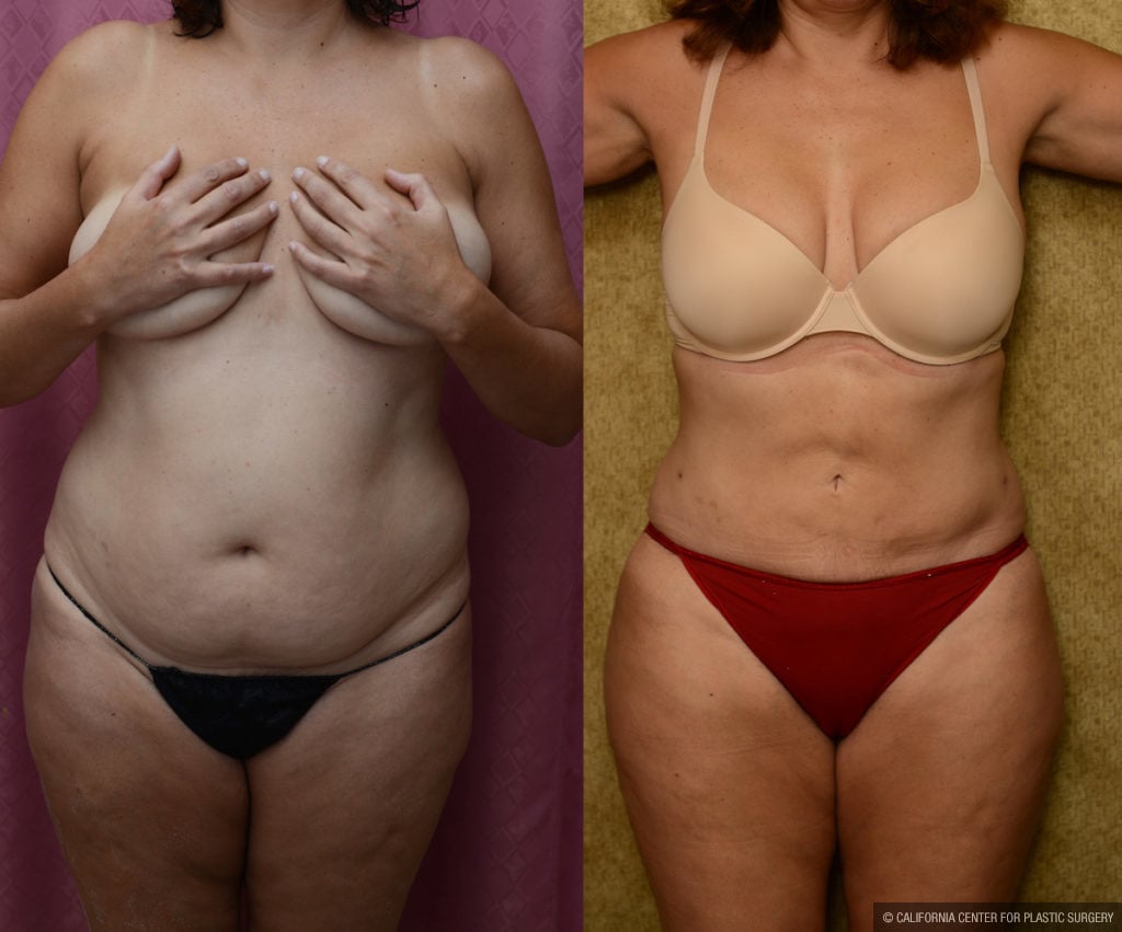 Liposuction Abdomen Medium Before & After Patient #11477