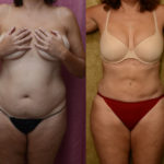 Liposuction Abdomen Medium Before & After Patient #11477