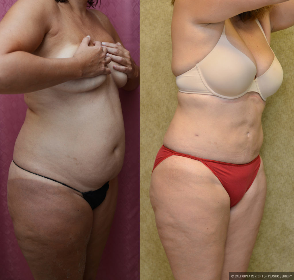 Liposuction Abdomen Medium Before & After Patient #11477