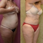 Liposuction Abdomen Medium Before & After Patient #11477