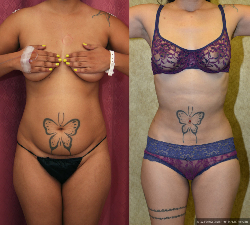 Liposuction Abdomen Medium Before & After Patient #11481