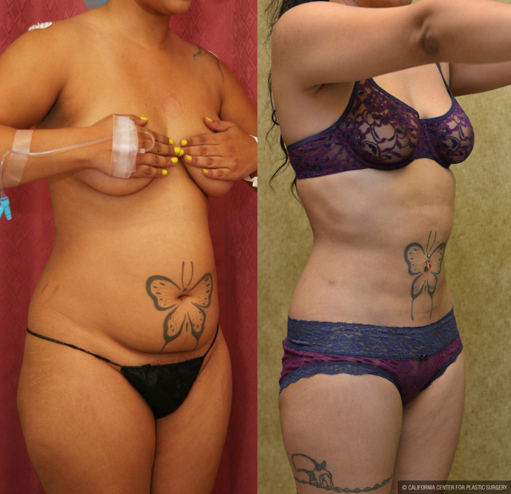 Liposuction Abdomen Medium Before & After Patient #11481