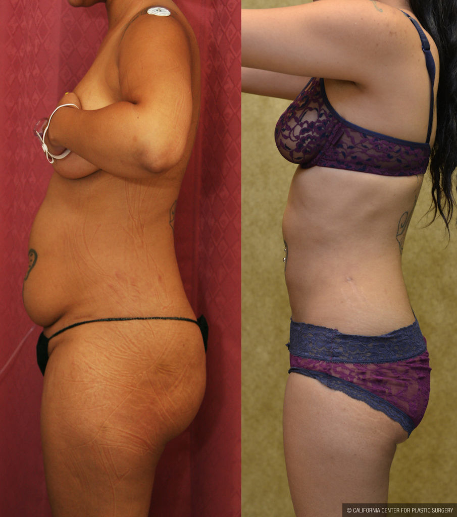 Liposuction Abdomen Medium Before & After Patient #11481