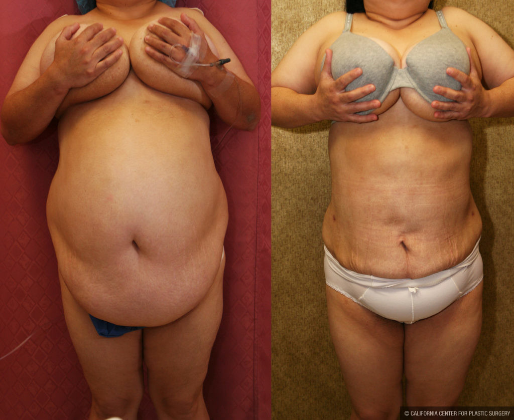 Liposuction Abdomen Plus Size Before & After Patient #11493