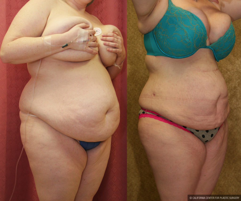 Liposuction Abdomen Medium Before & After Patient #11485
