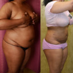 Liposuction Abdomen Medium Before & After Patient #11488