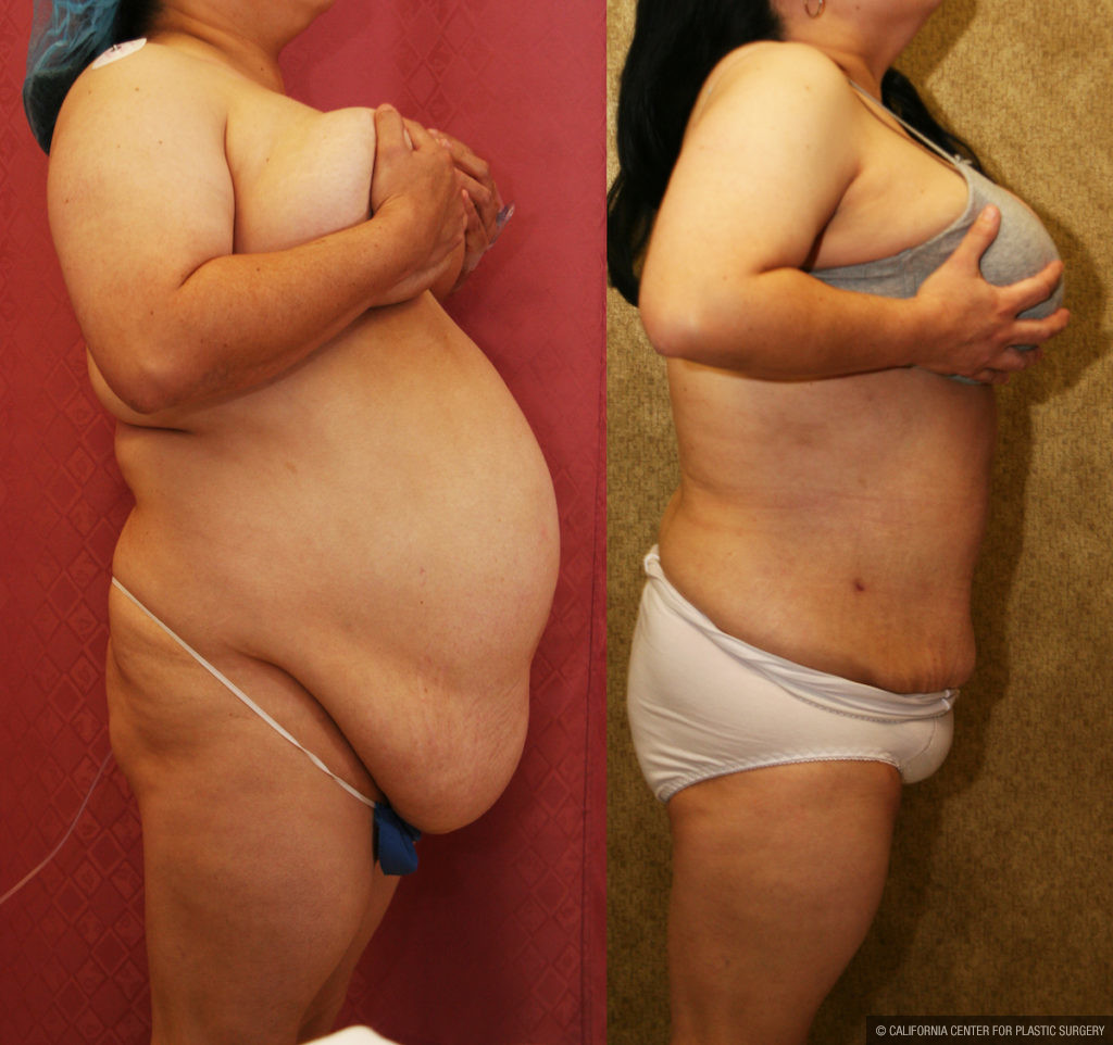 Liposuction Abdomen Plus Size Before & After Patient #11493