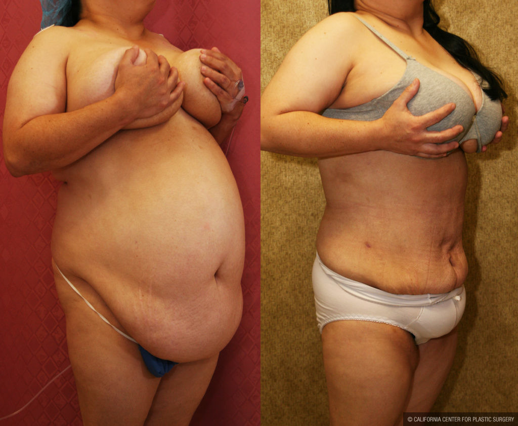 Liposuction Abdomen Plus Size Before & After Patient #11493