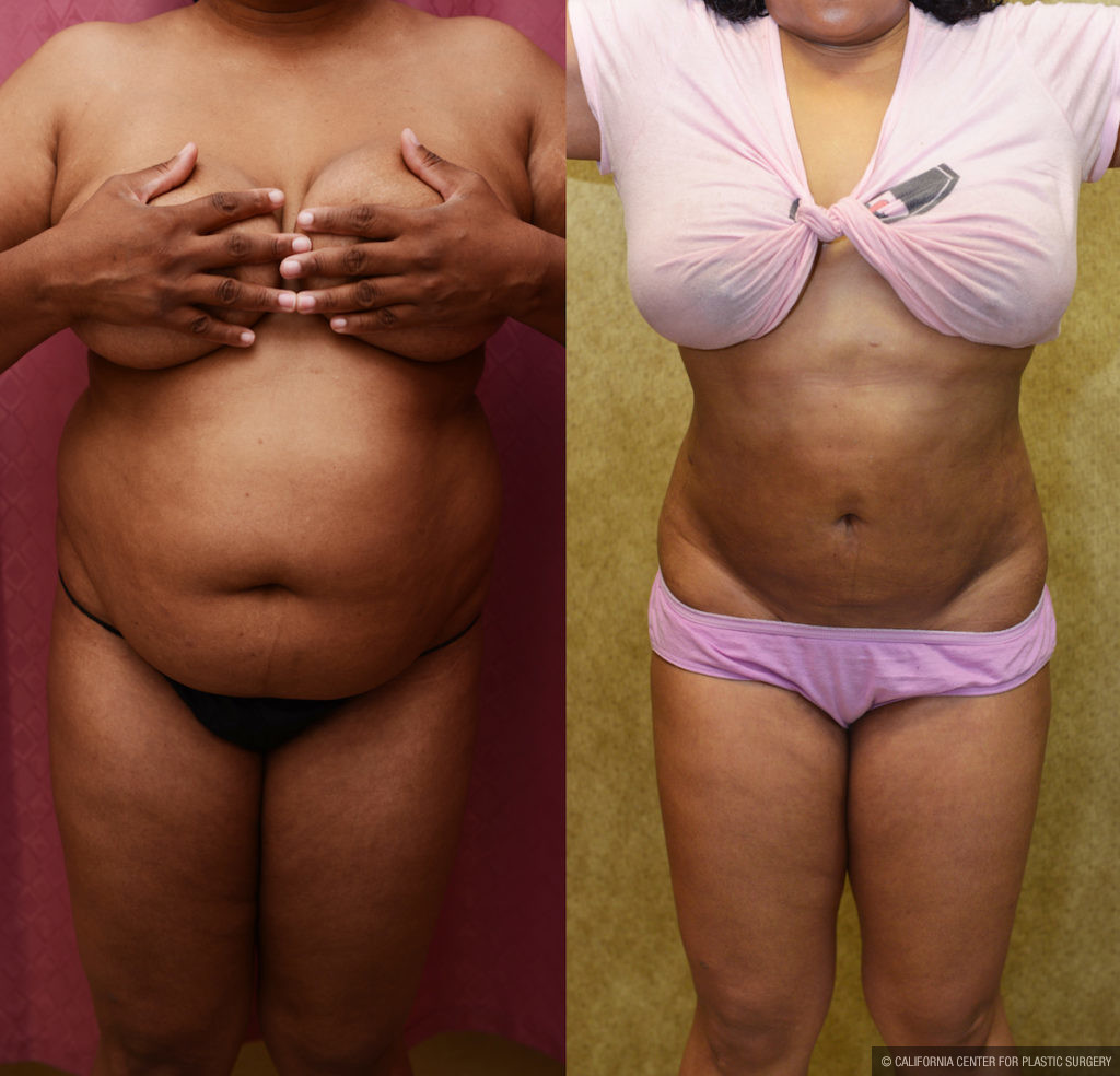 Liposuction Abdomen Medium Before & After Patient #11488