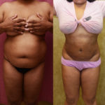 Liposuction Abdomen Medium Before & After Patient #11488