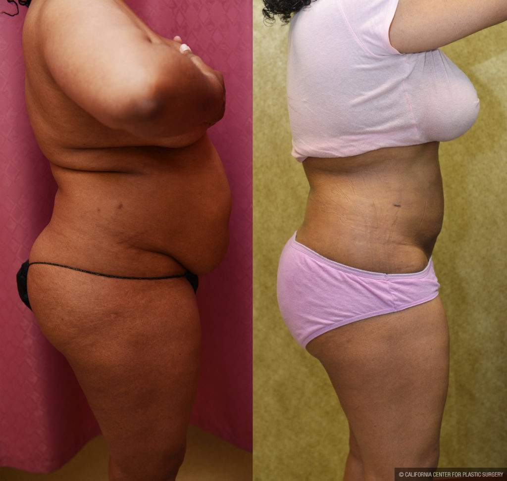 Liposuction Abdomen Medium Before & After Patient #11488