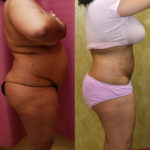 Liposuction Abdomen Medium Before & After Patient #11488