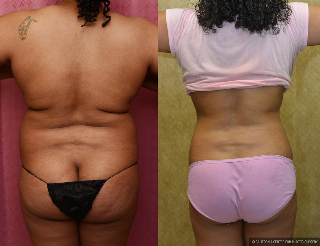 Liposuction Abdomen Medium Before & After Patient #11488