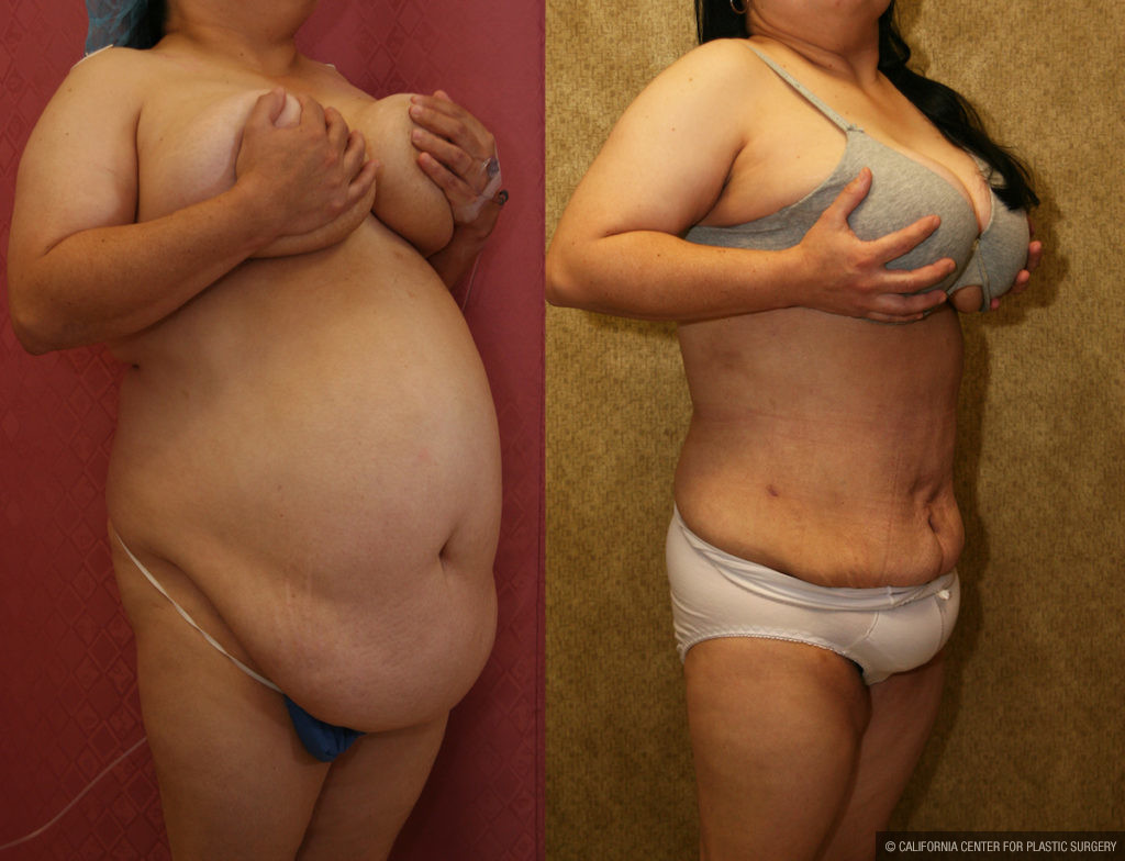Liposuction Abdomen Plus Size Before & After Patient #11509