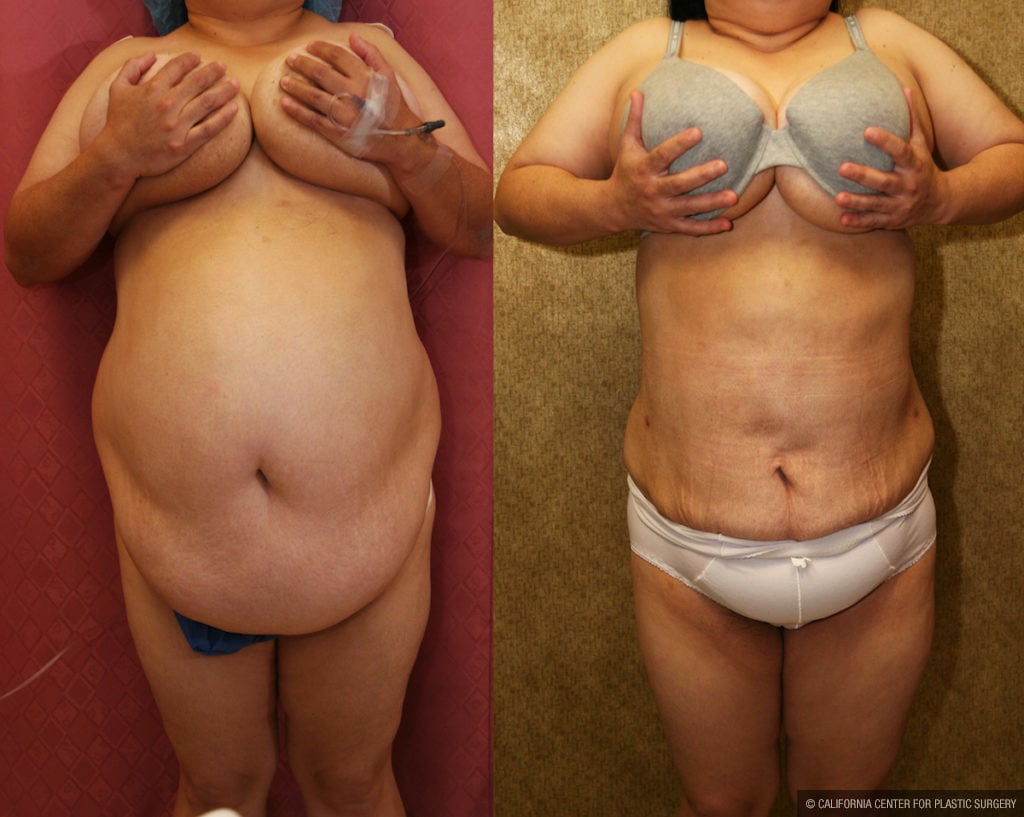 Liposuction Abdomen Plus Size Before & After Patient #11509