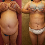 Liposuction Abdomen Plus Size Before & After Patient #11509