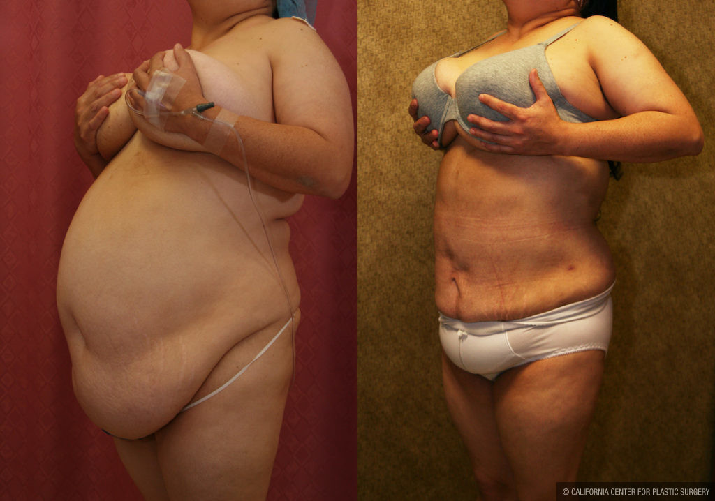 Liposuction Abdomen Plus Size Before & After Patient #11509
