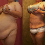 Liposuction Abdomen Plus Size Before & After Patient #11509