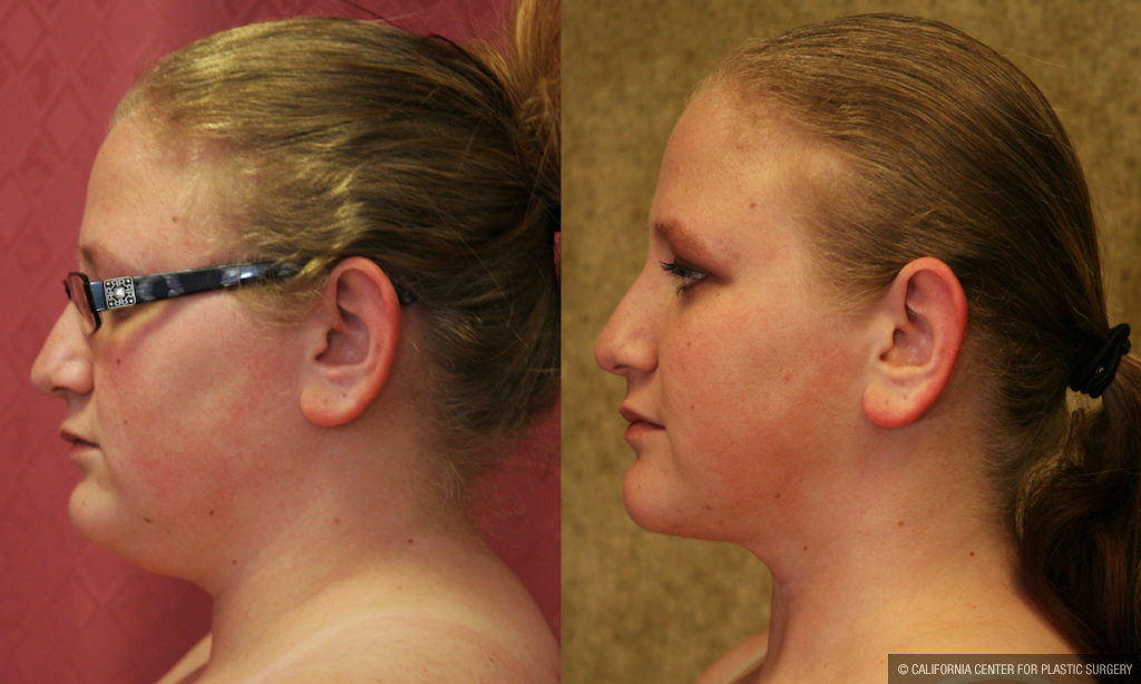 Neck & Face Liposuction Before & After Patient #11497