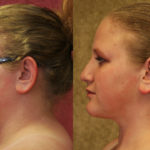 Neck & Face Liposuction Before & After Patient #11497
