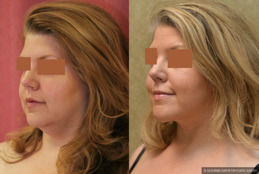 Neck & Face Liposuction Before & After Patient #11501