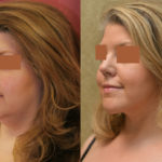 Neck & Face Liposuction Before & After Patient #11501