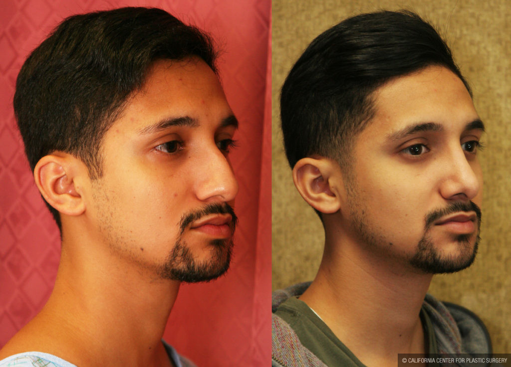 Male Rhinoplasty Before & After Patient #11514