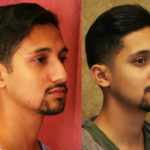 Male Rhinoplasty Before & After Patient #11514