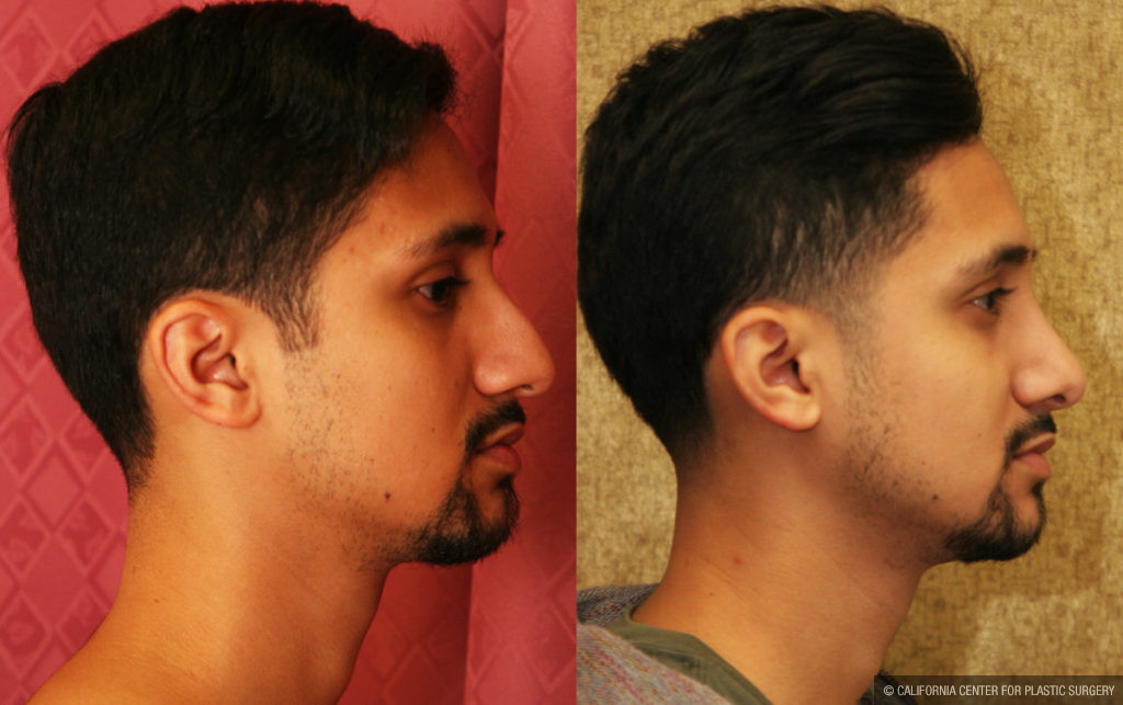 Male Rhinoplasty Before & After Patient #11514