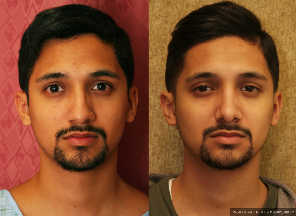 Male Rhinoplasty Before & After Patient #11514